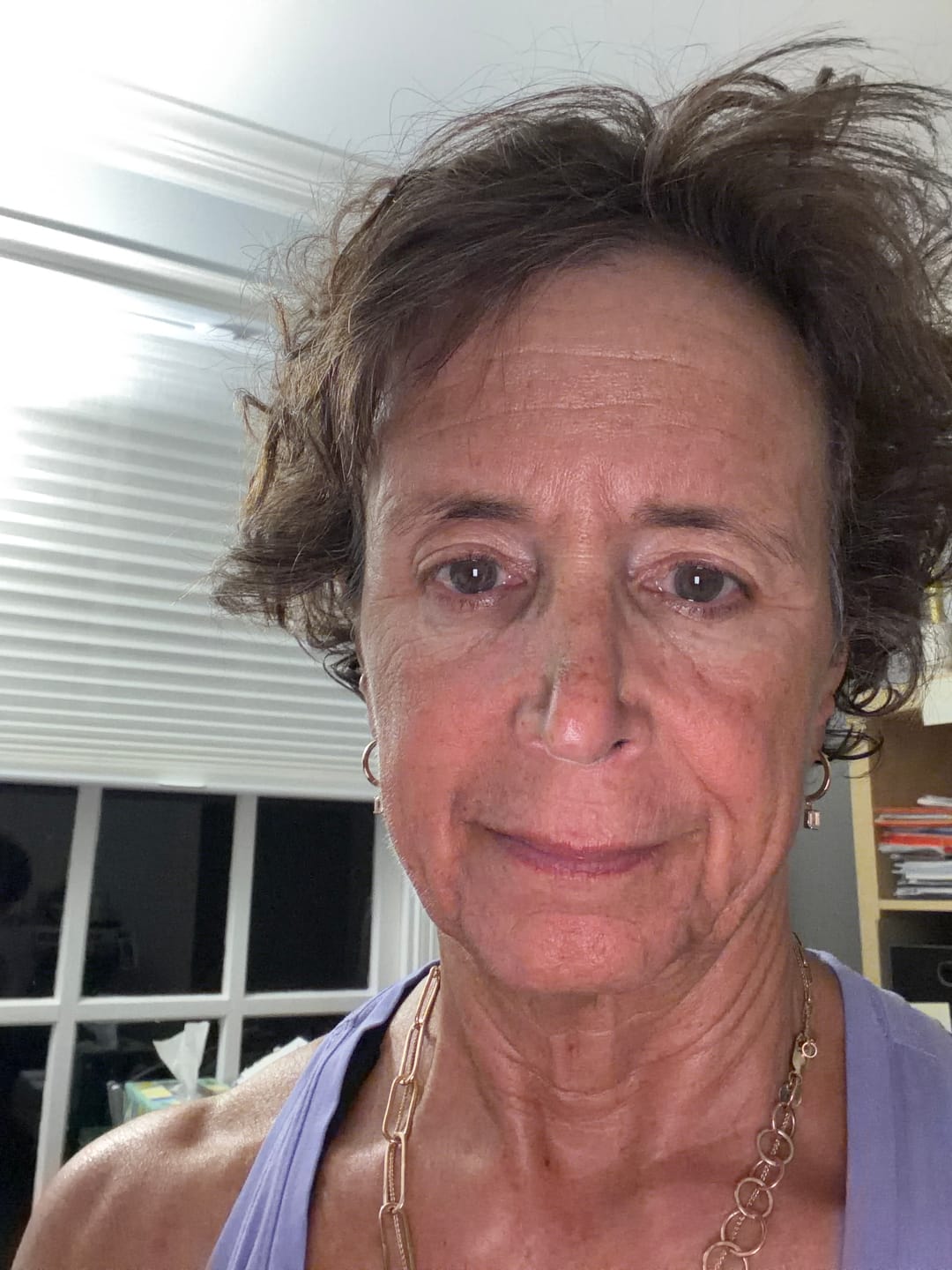 Customer photo review of Instant Rosacea, Acne & Redness Stopper