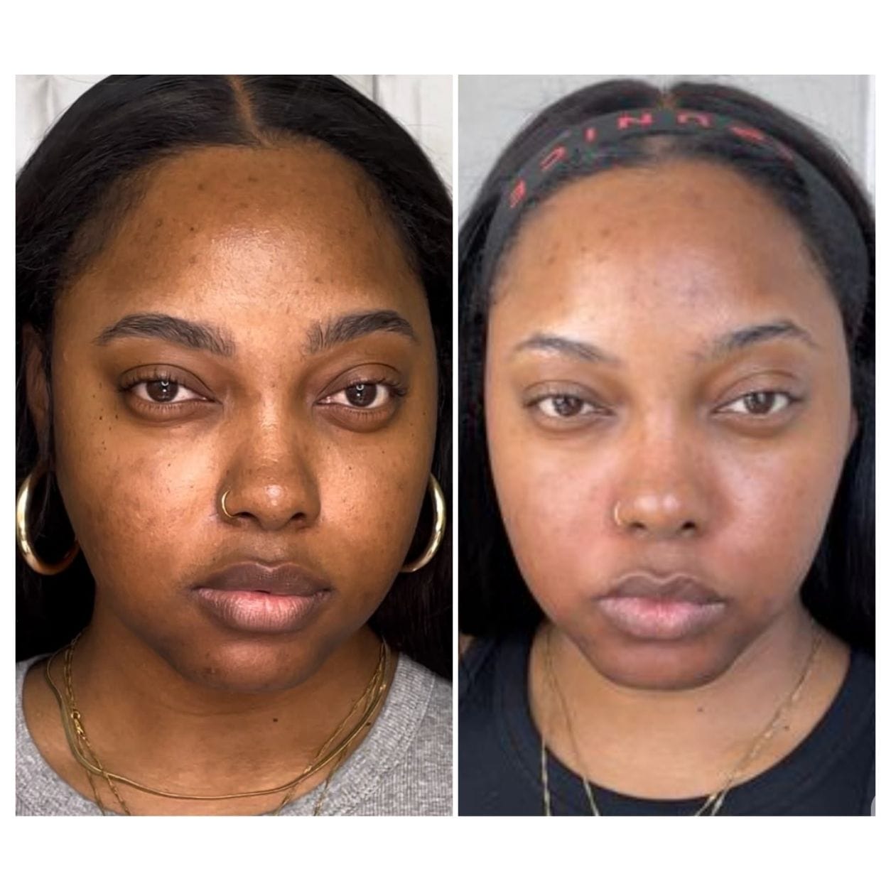 Customer photo review of Acne Care Duo: Glow Face Wash + Glow Serum