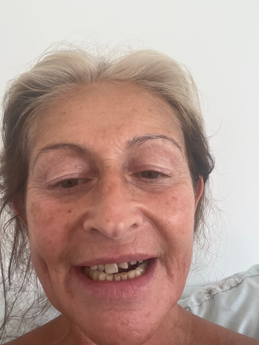 Customer photo review of Click-in Veneers 4.0