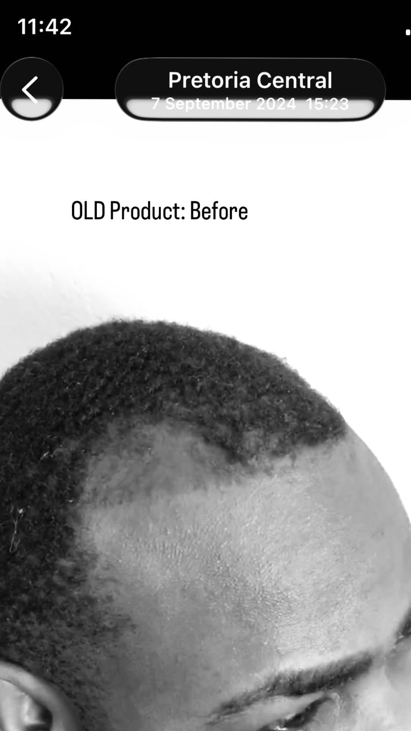 Customer photo review of Minoxidil 5% + DHT Blocker Solution - MEN ONLY, 3 Month supply