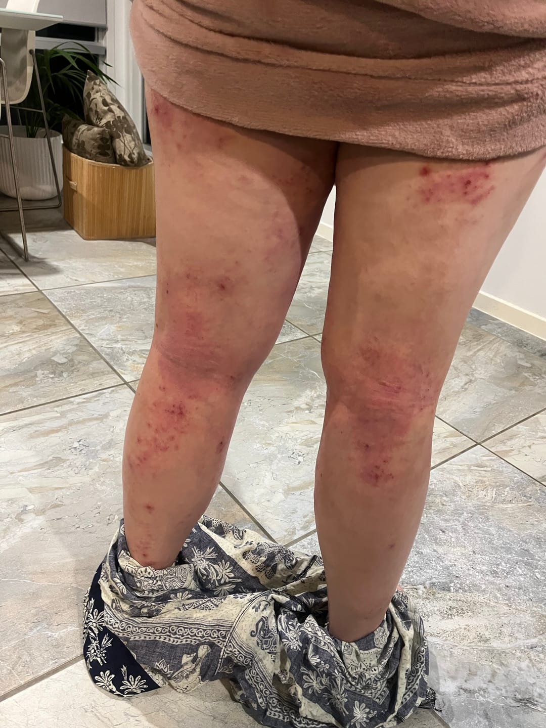 Customer photo review of Korean Honey Eczema-Soothing Cream for your kids