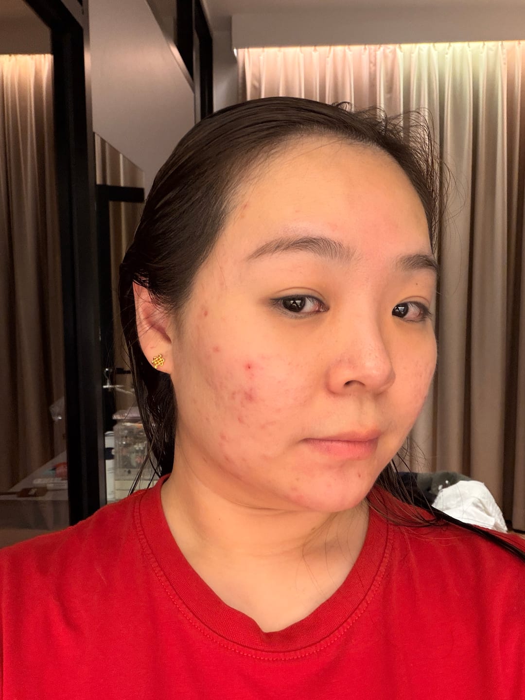 Customer photo review of Acne Formula