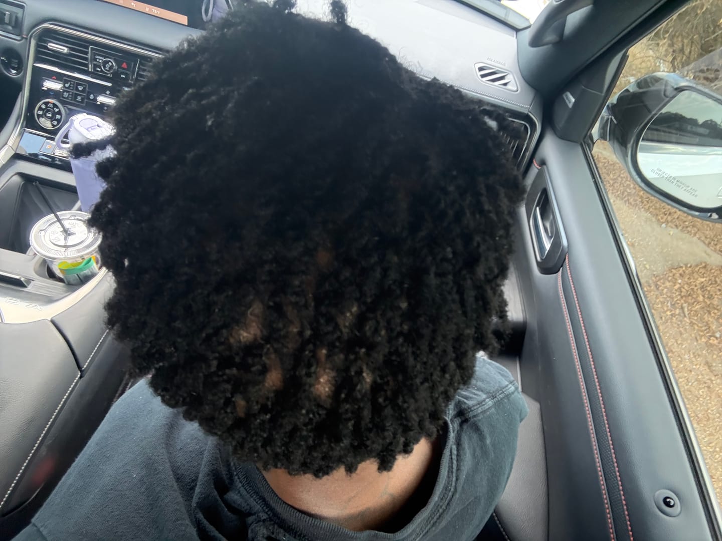 Customer photo review of Scalp Therapy System