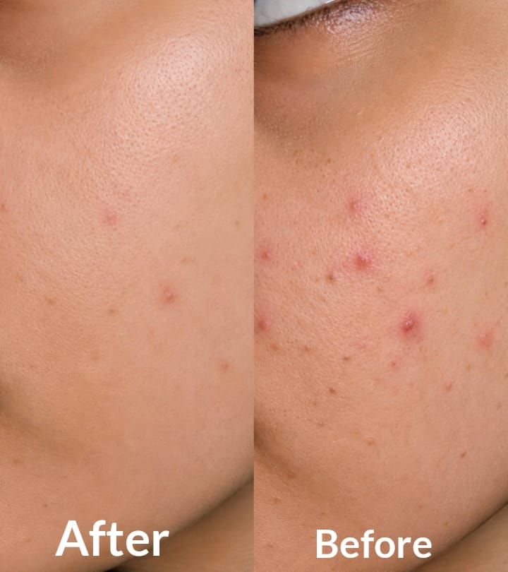 Customer photo review of Clarevo Anti Acne Soap