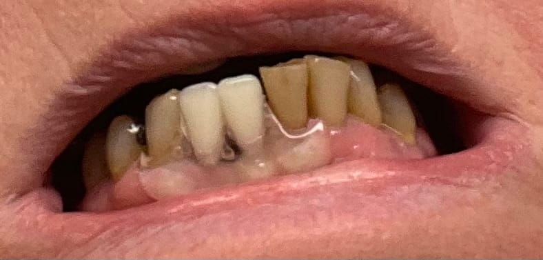 Customer photo review of Unilateral Partial Denture