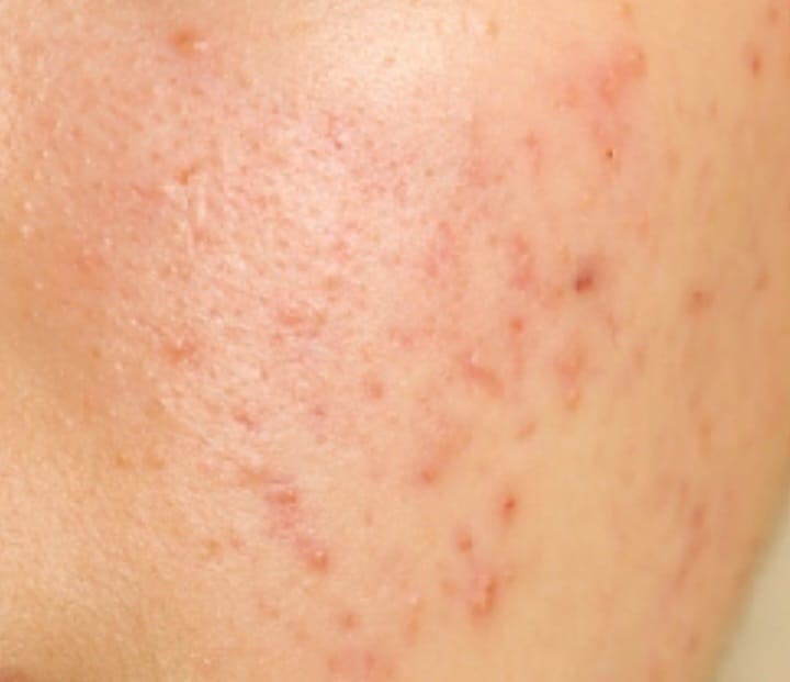 Customer photo review of Clarevo Salicylic Acid Facewash