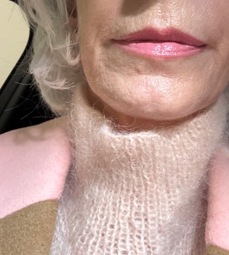 Reviewer's skin around their lips after using the Seranova Micro Infusion System to help with vertical lines.