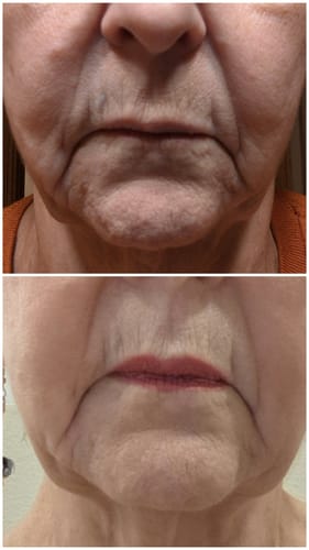 Reviewer's skin around mouth, showing facial area before and after using The Micro Infusion System.