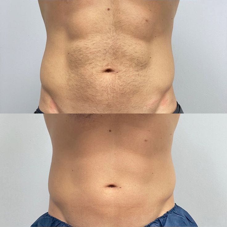 Customer photo review of Dermave™ Electric Trimmer 2.0 for Men