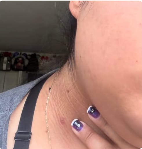 Customer photo review of Schmerzfreies Stielwarzen-Entfernungsset