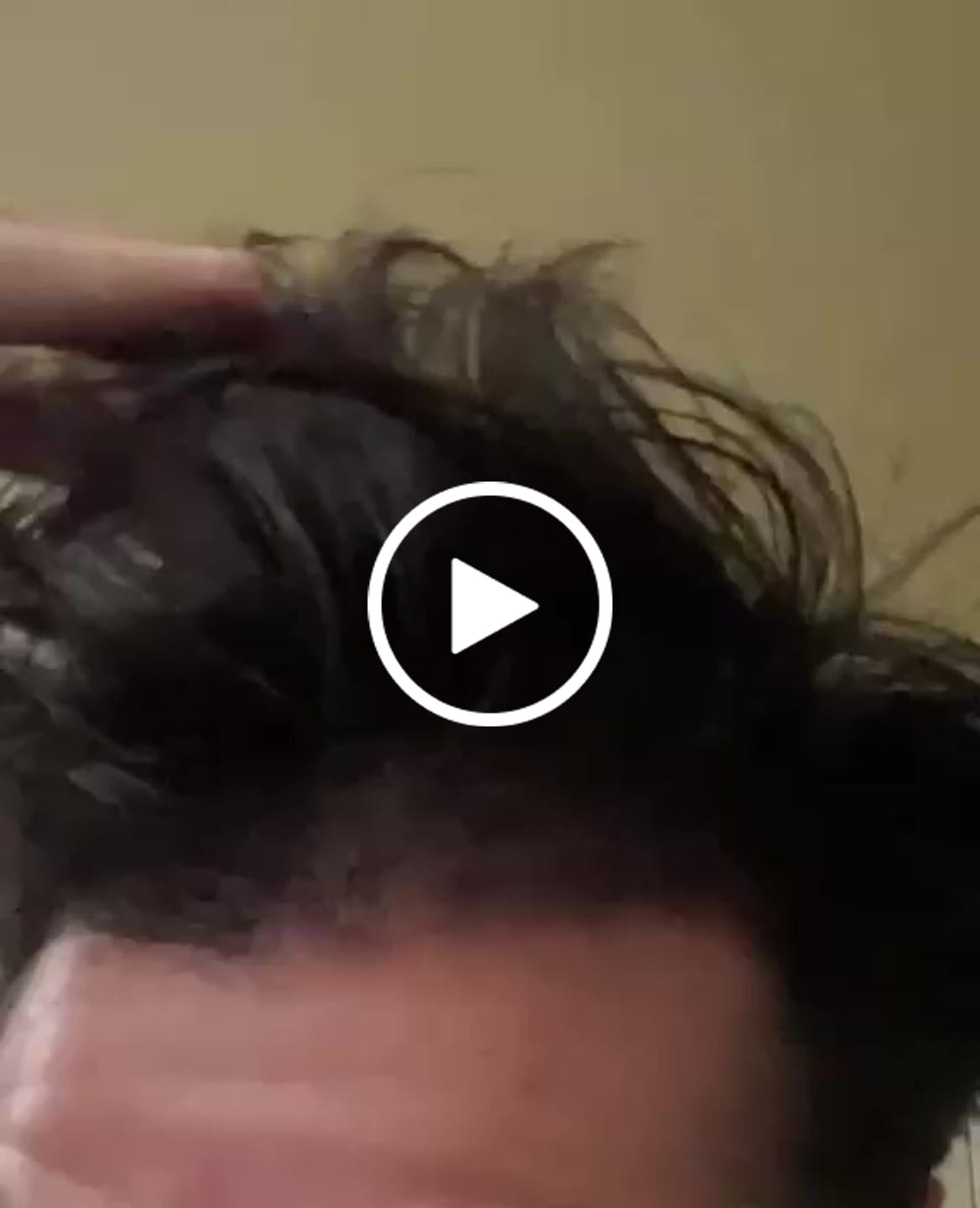 Customer video review of Minoxidil 5 mg con 90 tabletas para 3 meses de tratamiento