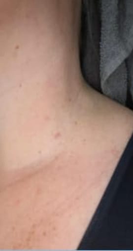 Customer photo review of Schmerzfreies Stielwarzen-Entfernungsset