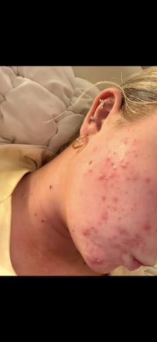 Reviewer's face showing skin texture before starting the Advanced Program, with visible irritation and redness.