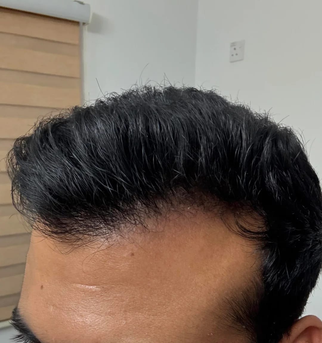 Customer photo review of VITAFOAM ™ Hair Growth Formula