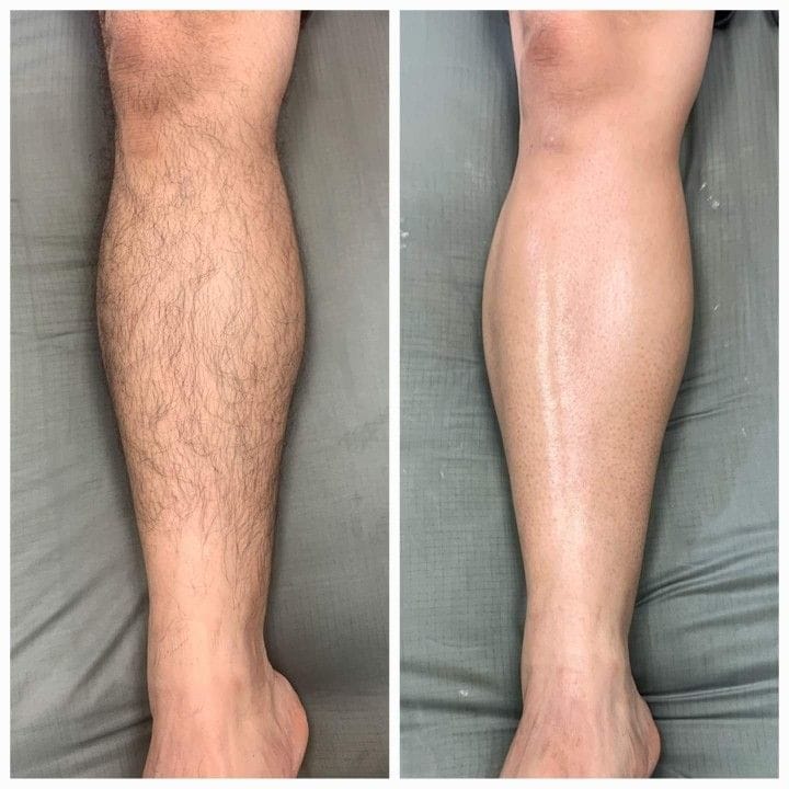 Customer photo review of Dermave™ Electric Trimmer 2.0 for Men