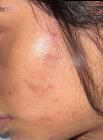 Customer photo review of Clarevo Salicylic Acid Facewash