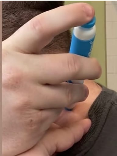 Customer photo review of Schmerzfreies Stielwarzen-Entfernungsset