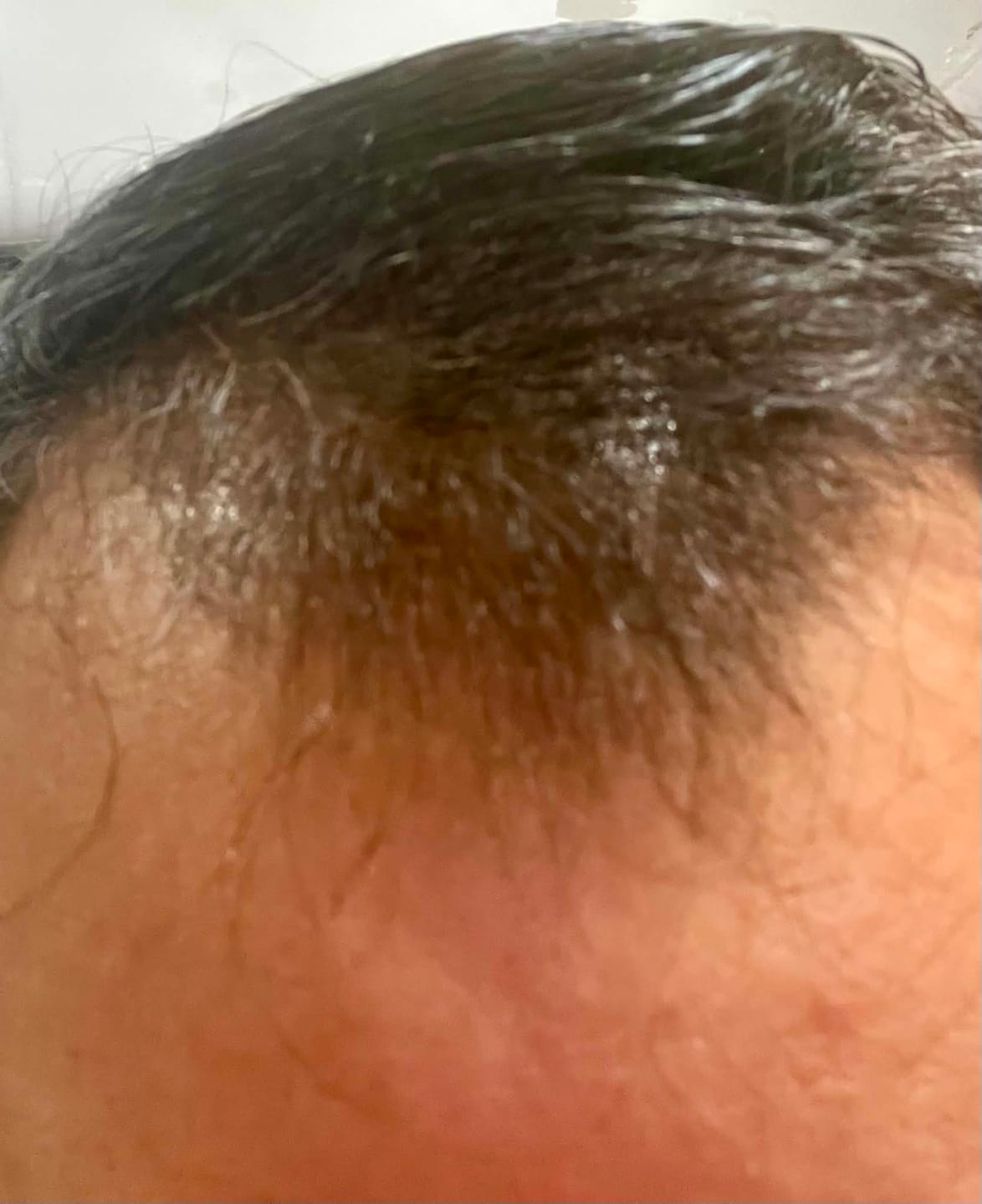 Customer photo review of Minoxidil 5 mg con 90 tabletas para 3 meses de tratamiento