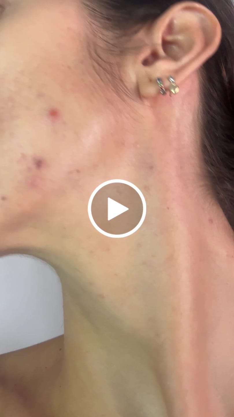 Customer video review of A CONTROL - ACNÉ HORMONAL & RESISTENCIA A LA INSULINA