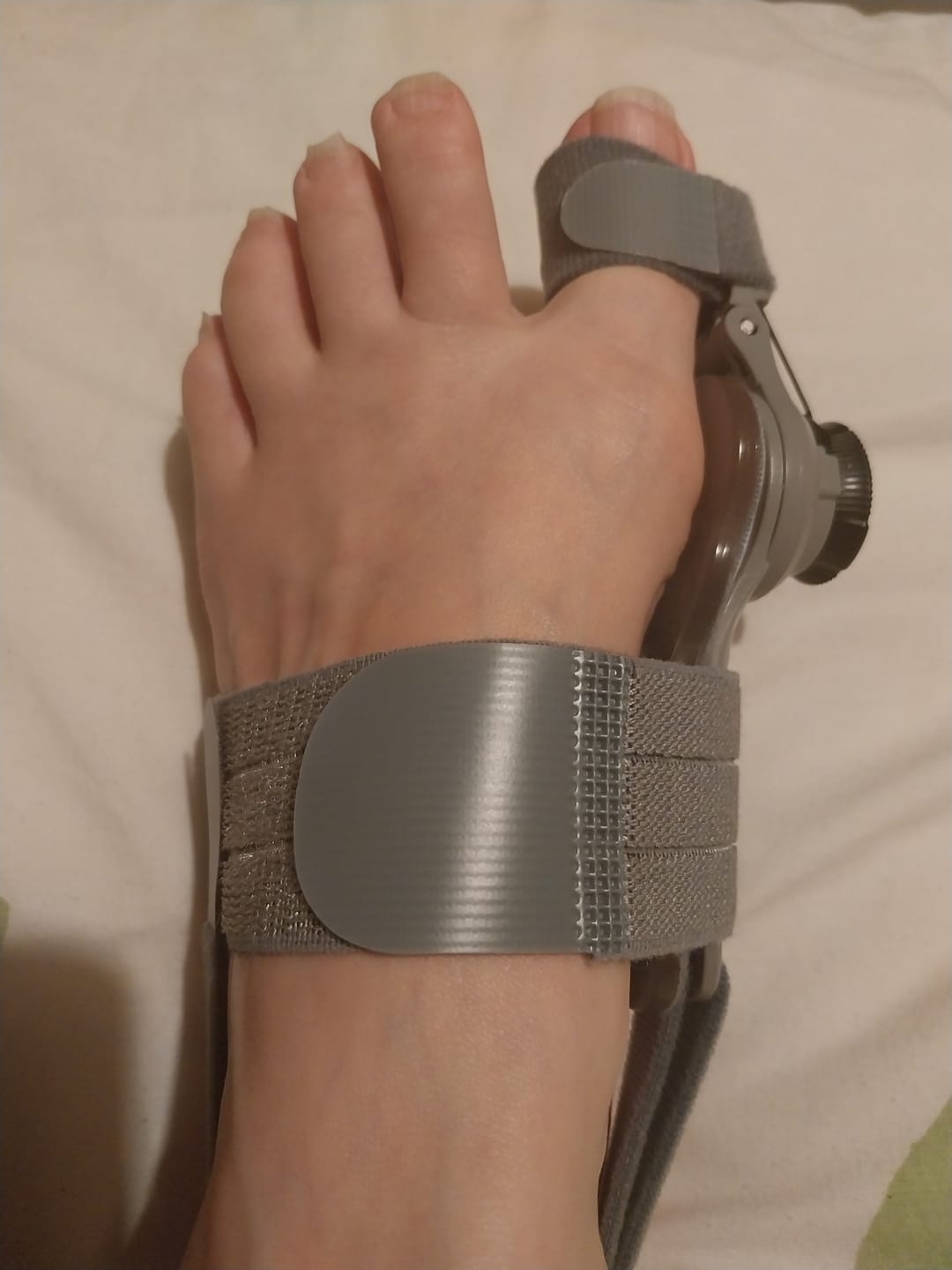 Customer photo review of Treatmedy™ Bunion Fix