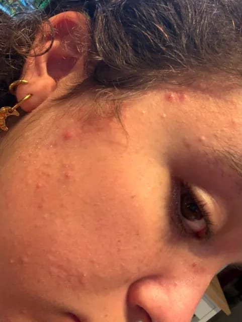 Customer photo review of Kill Acne & Redness Ritual