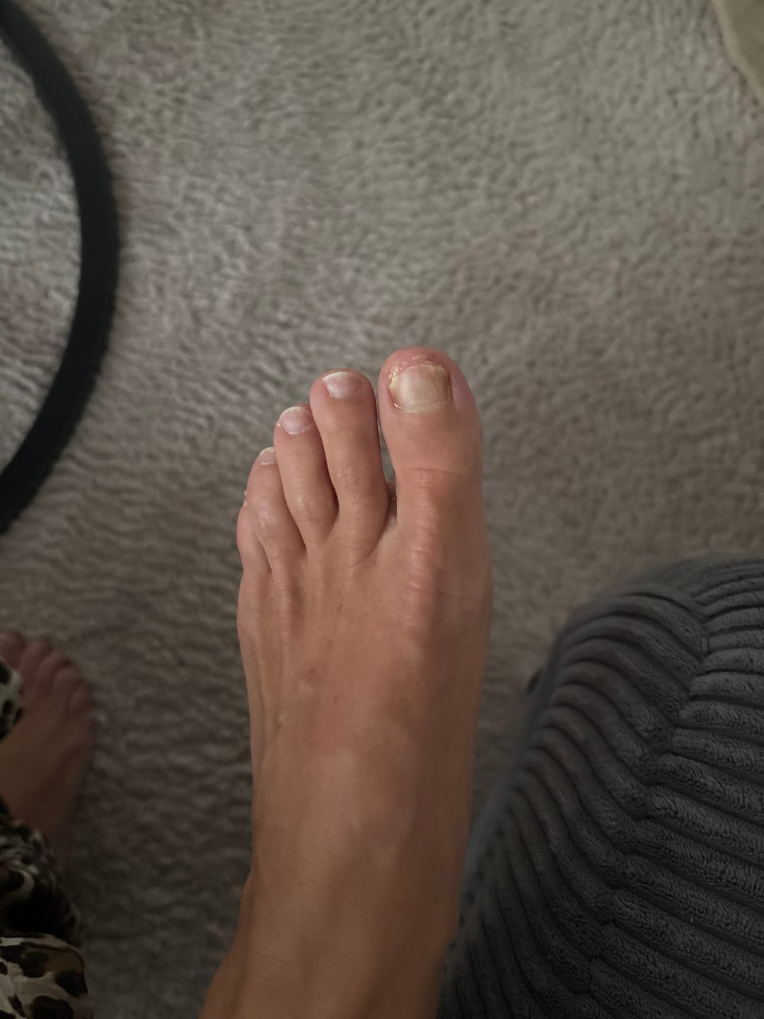 Customer photo review of Propolis Nagelserum, 10ml - Akutpflege bei Nagelpilz, mit hochdosiertem Bio-Propolisextrakt sowie Teebaumöl, Zink, Selen & Biotin, für gesunde & starke Nägel