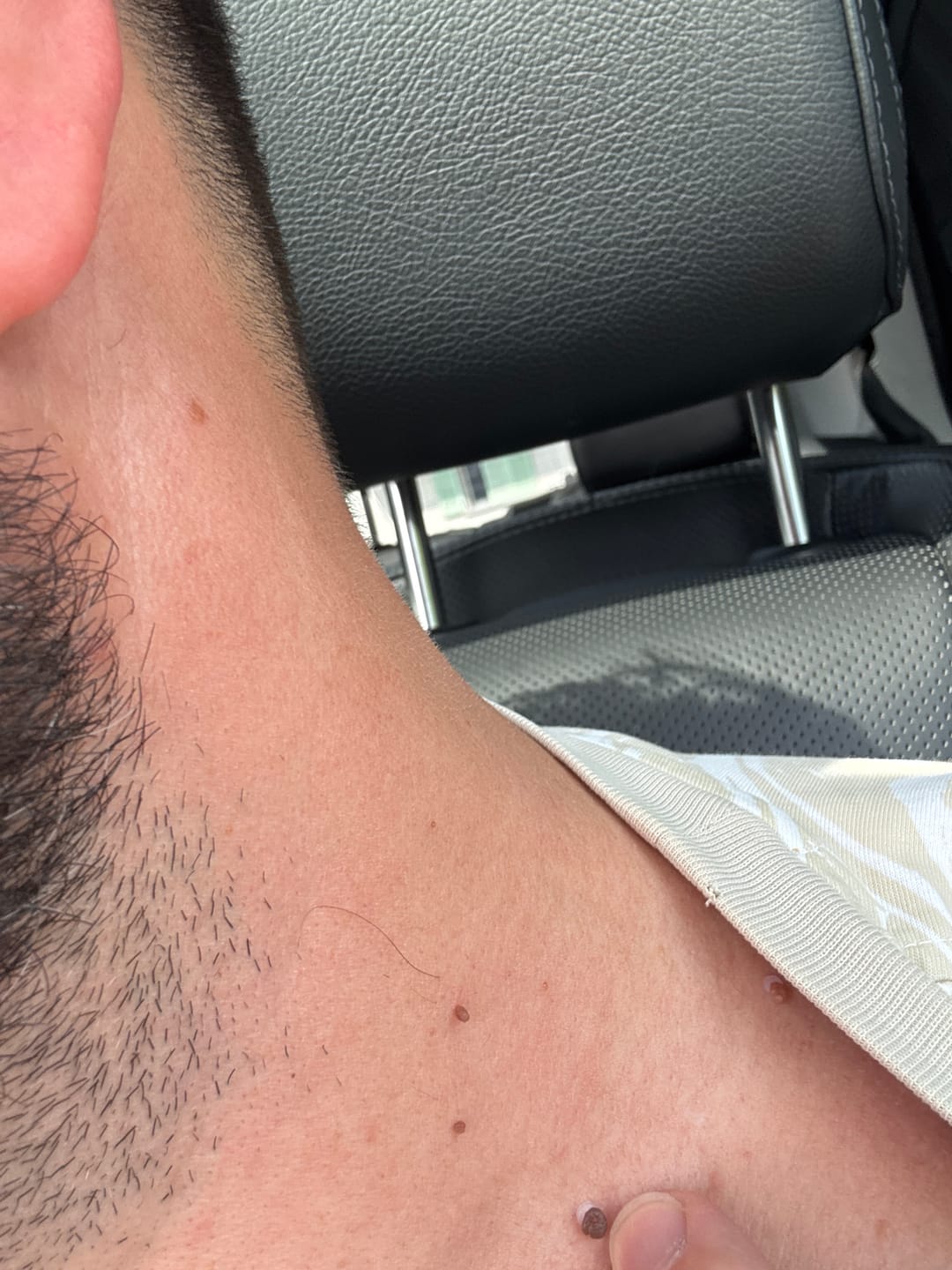 Customer photo review of Kit Anti-Acrochordons Vantyx