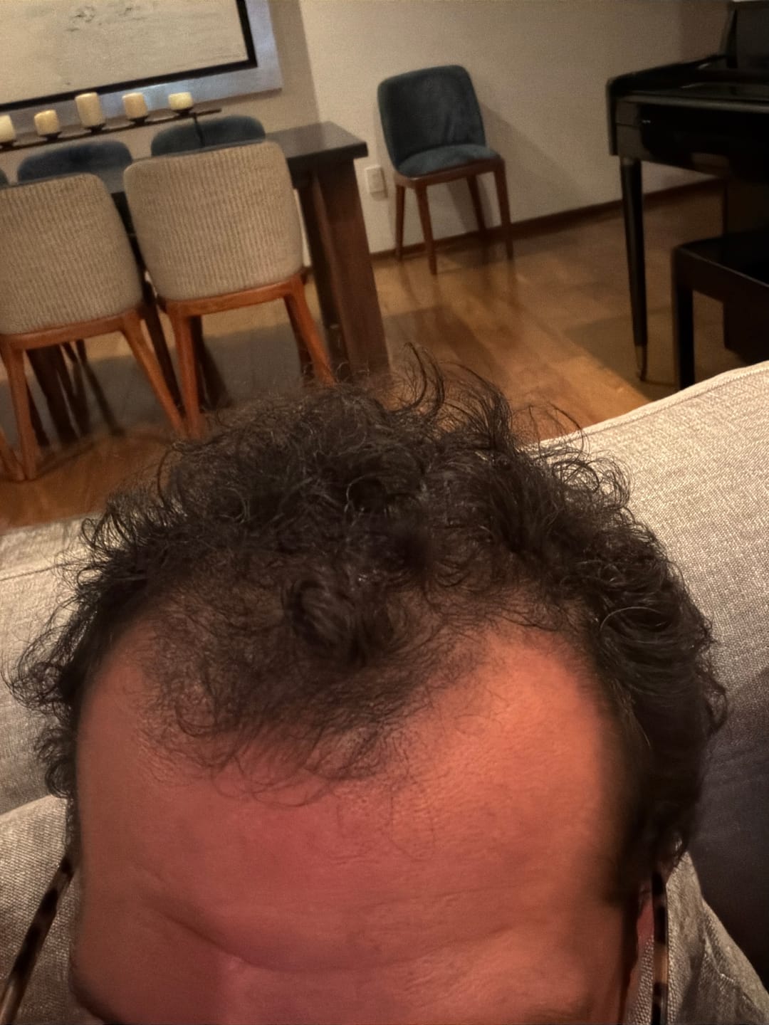 Customer photo review of Minoxidil 5 mg + Dutasterida 0.5 mg  90 tabletas para 3 meses de tratamiento