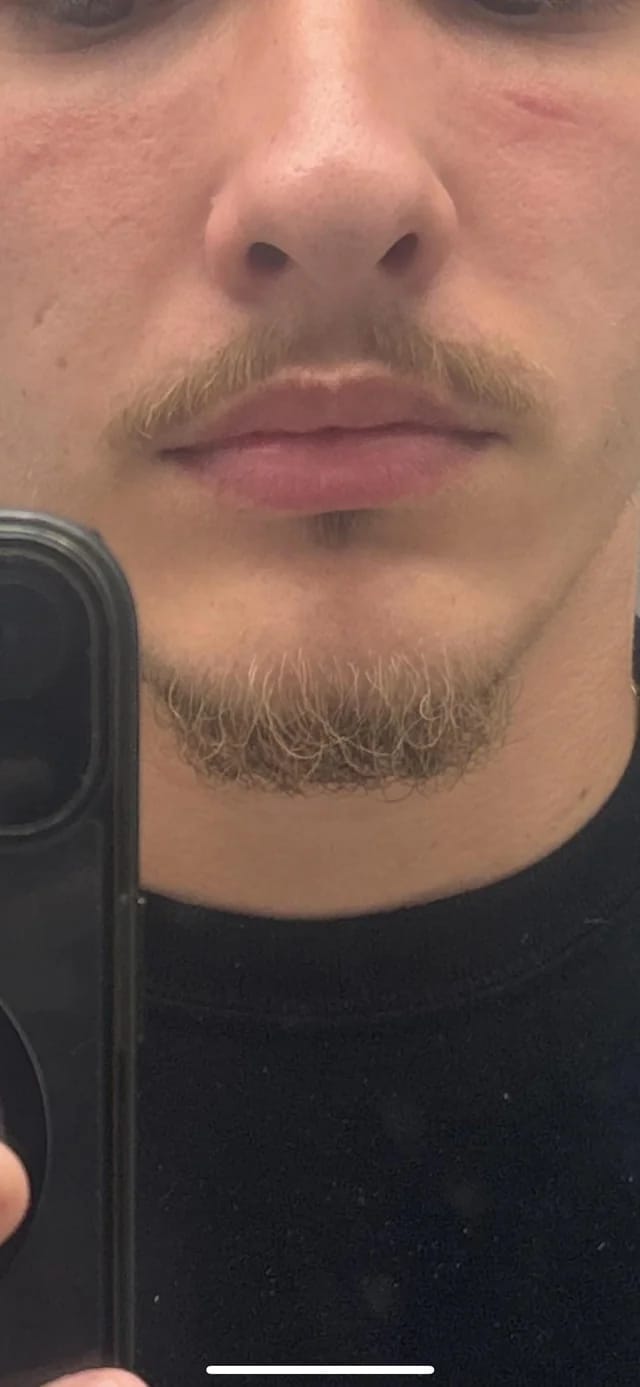 Customer photo review of Reverse - Beard Growth Serum