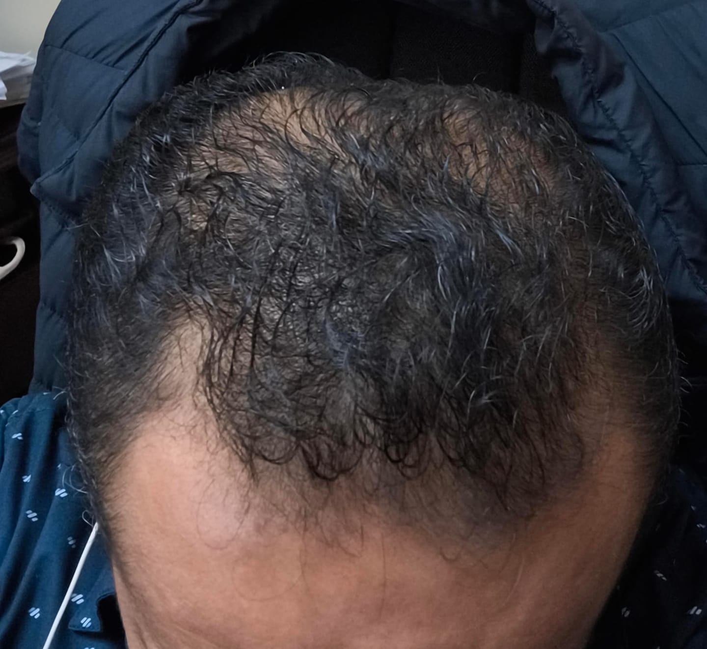 Customer photo review of Minoxidil+DHT Blocker Solution - MEN ONLY, 3x60ml pack