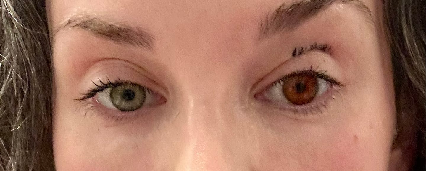 Customer photo review of Eyeling FL-41 light sensitivity contact lenses
