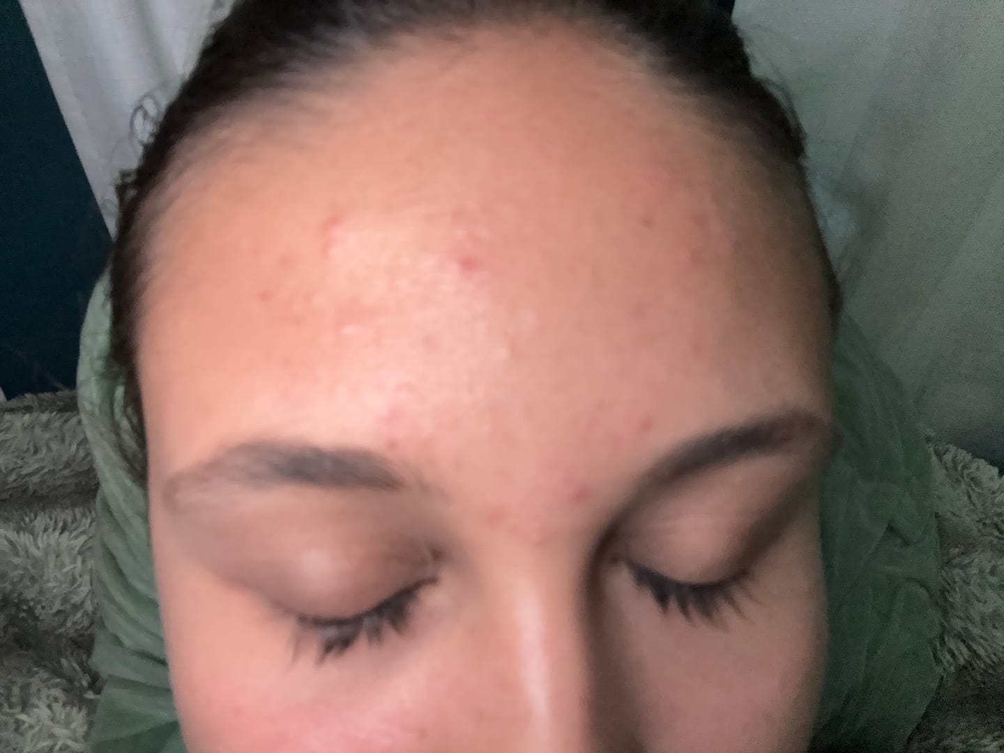 Customer photo review of Pimple Stopper Night Balm