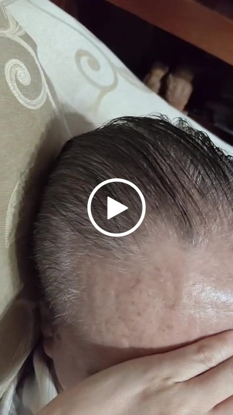 Customer video review of Minoxidil 5 mg con 90 tabletas para 3 meses de tratamiento