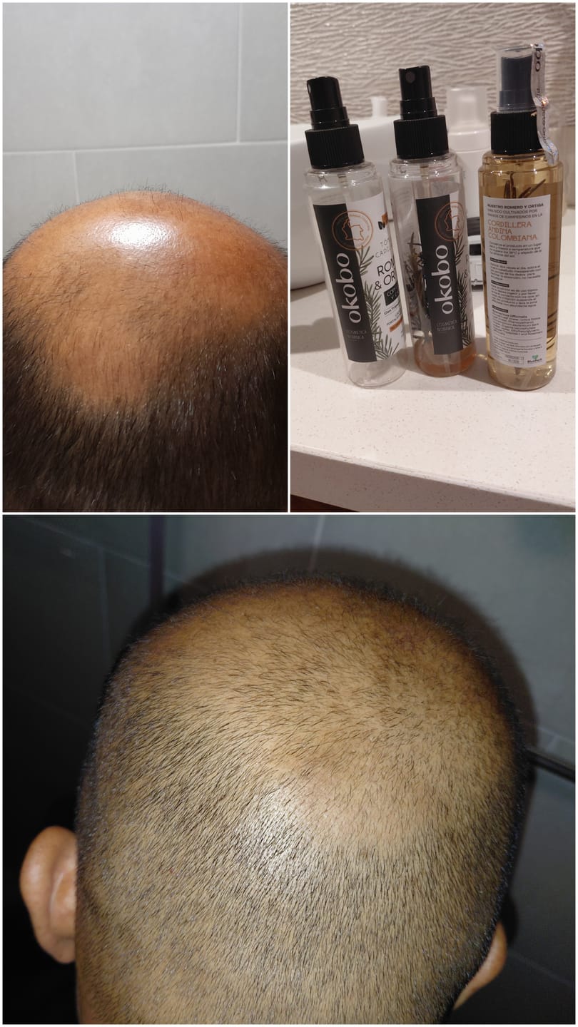 Customer photo review of 3 Tónicos Capilares de Romero · Crecimiento y Anticaída + Dermaroller de regalo