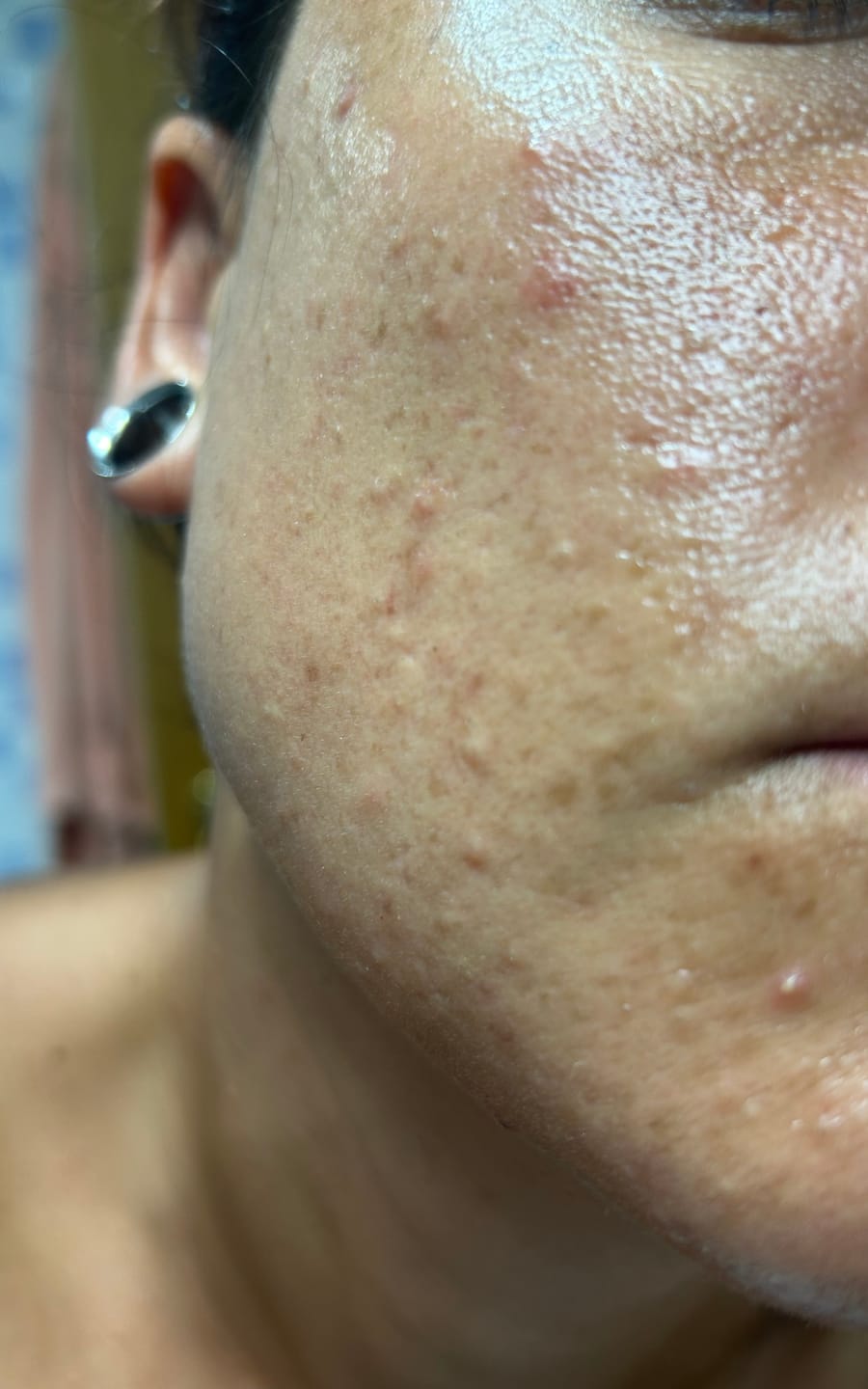 Customer photo review of A CONTROL - ACNÉ HORMONAL & RESISTENCIA A LA INSULINA