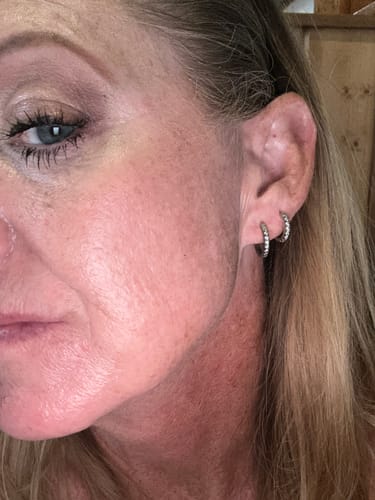 Customer's side profile showing skin texture after using the Micro Infusion System.