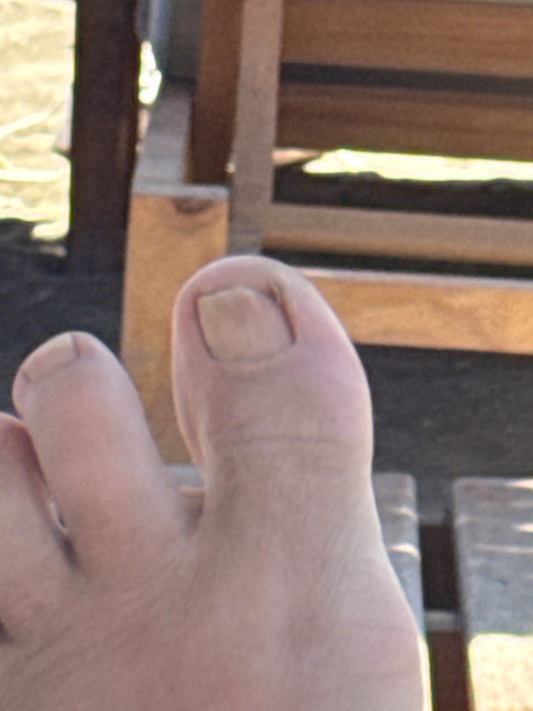 Customer photo review of VELCURA™ Fungal Nail Patches