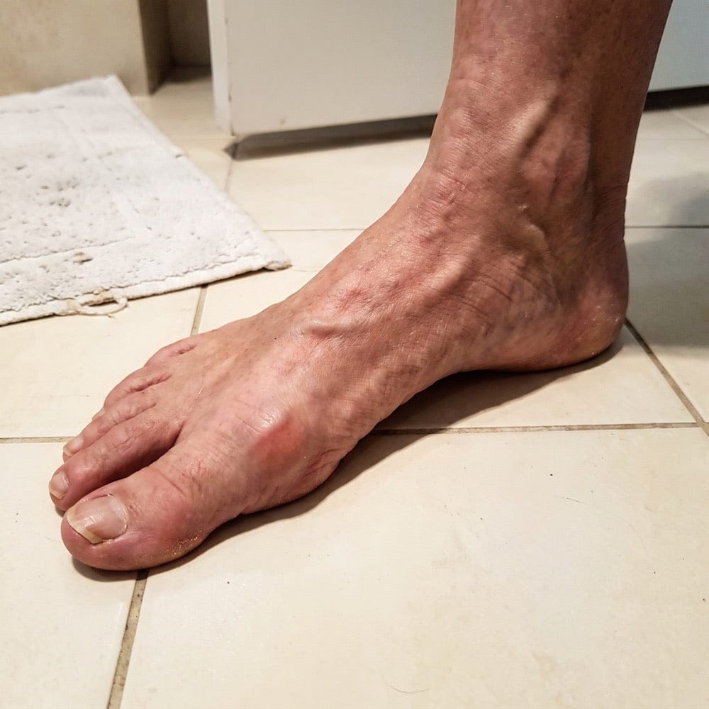 Customer photo review of Correcteur Pied Confort – Retrouvez une marche plus agréable au quotidien