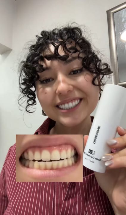 Customer photo review of Dentéa™ V34 — Blanqueamiento Dental en Casa