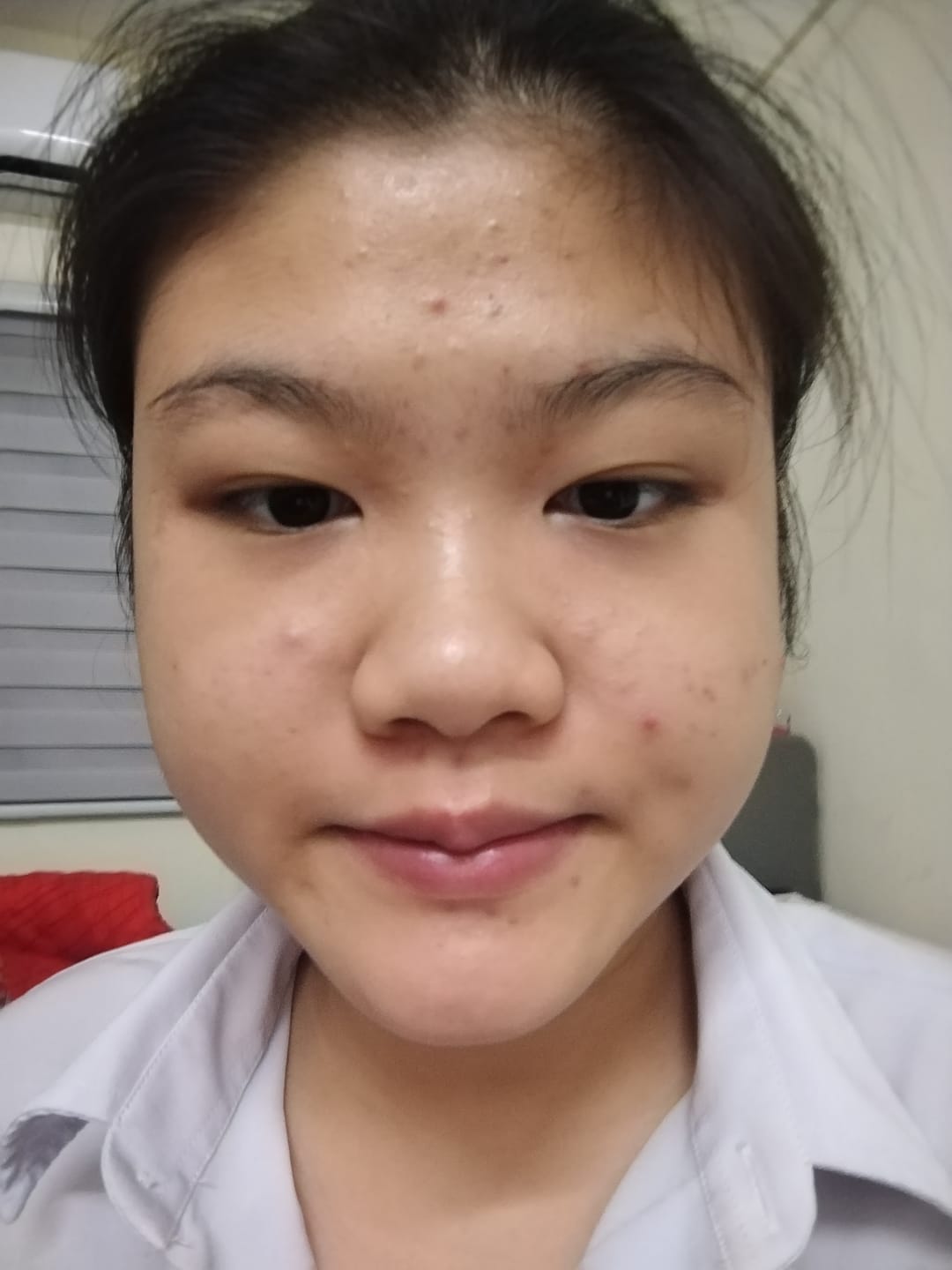 Customer photo review of Ventamin Clear It+: Doctor-Formulated Drink Mix for Acne & Breakout Control