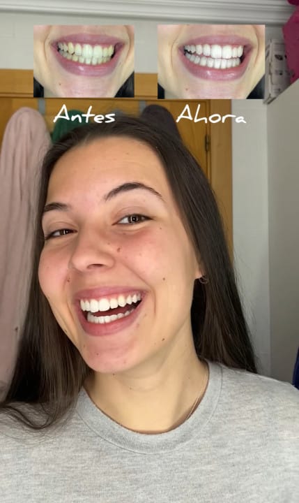 Customer photo review of Dentéa™ V34 — Blanqueamiento Dental en Casa
