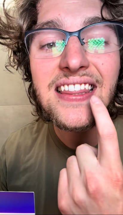 Customer photo review of Dentéa™ V34 — Blanqueamiento Dental en Casa