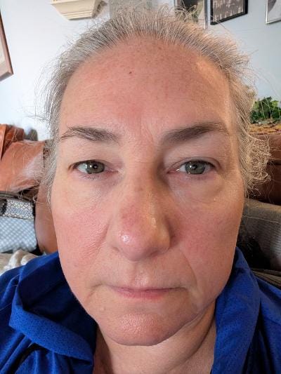 Customer photo review of 2 Month Supply - Micro Infusion Patches