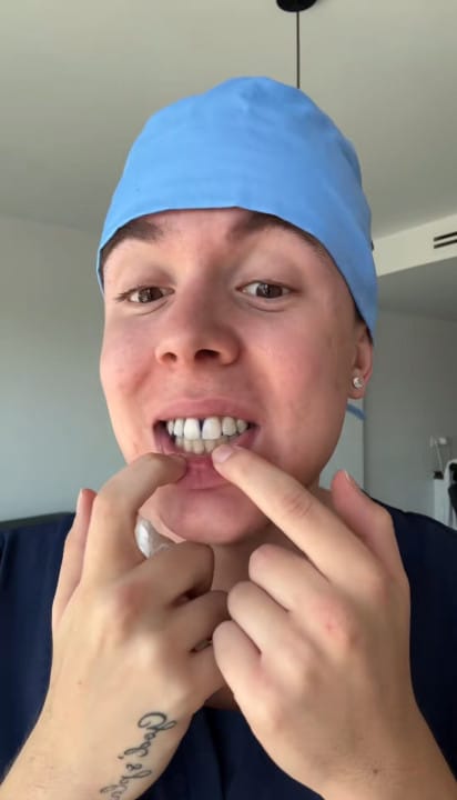 Customer photo review of Dentéa™ V34 — Blanqueamiento Dental en Casa