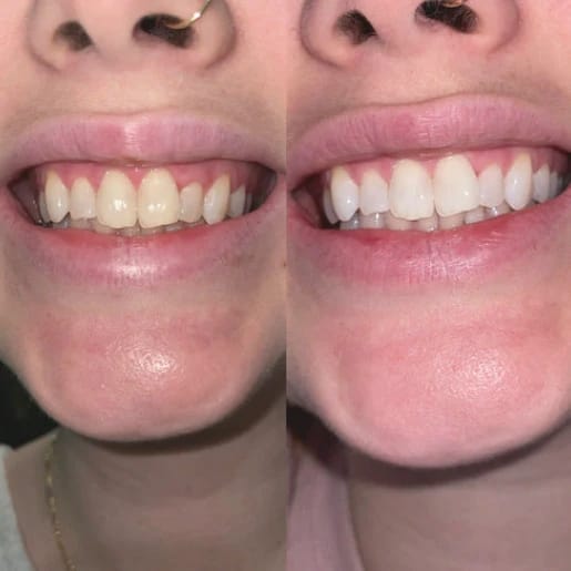 Customer photo review of Dentéa™ V34 — Blanqueamiento Dental en Casa