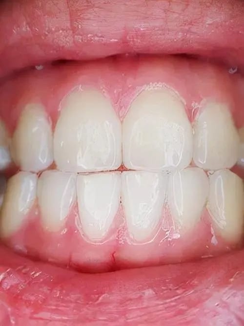 Customer photo review of Dentéa™ V34 — Blanqueamiento Dental en Casa