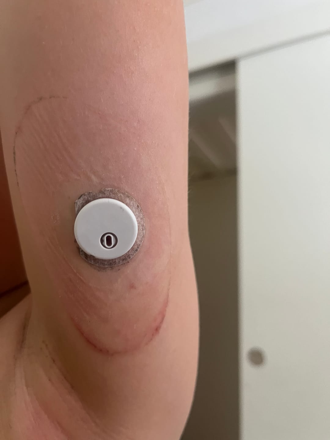 Customer photo review of Freestyle Libre 3 Sensorplåster Sveriges Edition – Vattentåliga overpatches