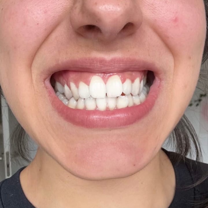 Customer photo review of Dentéa™ V34 — Blanqueamiento Dental en Casa