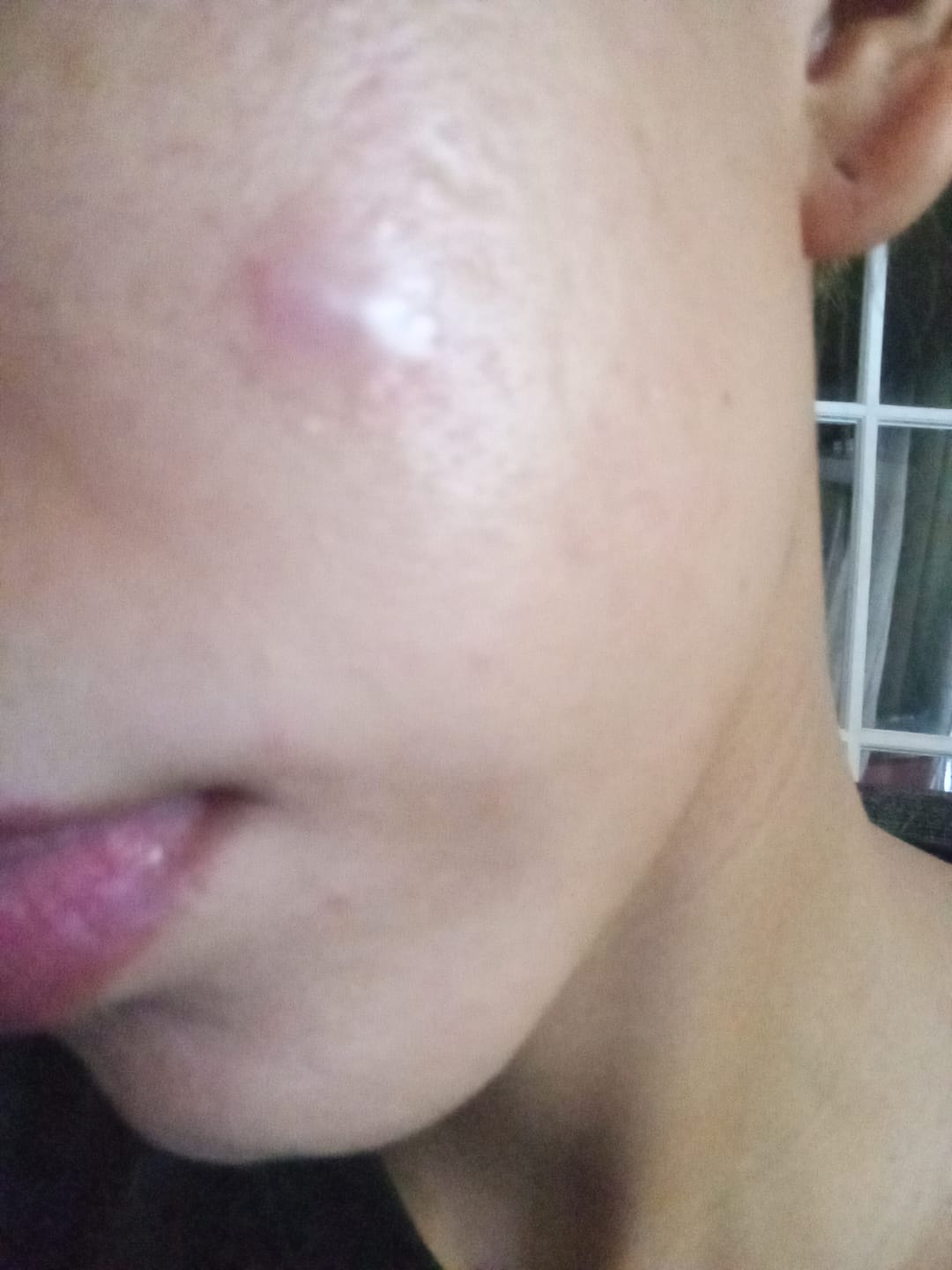 Customer photo review of COSRX - Acne Pimple Master Patch 24 piezas | Parches para Acné