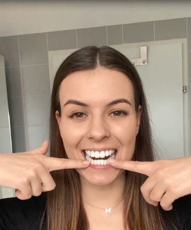 Customer photo review of Dentéa™ V34 — Blanqueamiento Dental en Casa